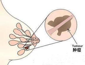 乳腺術后護理方法有哪些