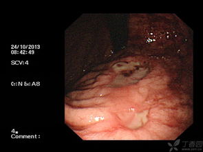 內(nèi)鏡下潰瘍止血的方法有哪些