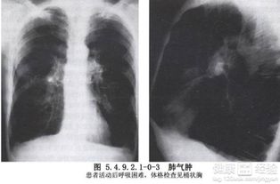 肺氣腫有哪些較好的治療方法
