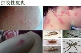 防蟲叮咬的方法都有哪些