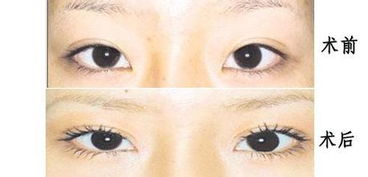 開眼角手術(shù)后怎樣護(hù)理方法有哪些