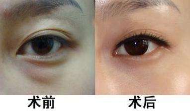 眼袋手術(shù)檢查哪些方法