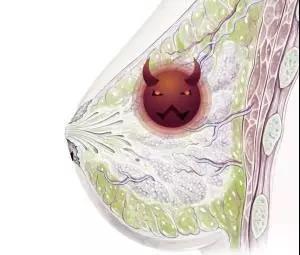 乳腺包塊切除方法有哪些