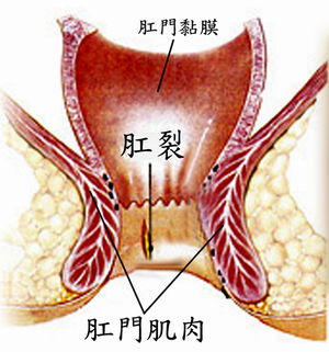 肛裂有效的治療方法有哪些