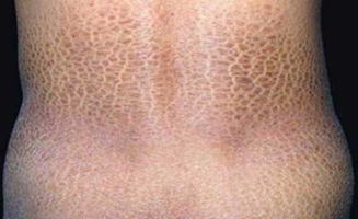 治療魚(yú)鱗病方法有哪些