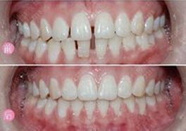 牙齒矯正有什么方法有哪些