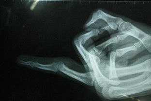 手關(guān)節(jié)軟組織挫傷怎么處理？(軟組織挫傷多久能好？)