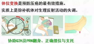 壓瘡的護理(壓瘡護理論文)