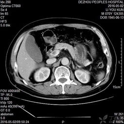 注意事項,觀察,腦水腫