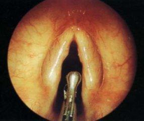 聲帶癌聲帶切除術(shù)后有何注意事項(xiàng)
