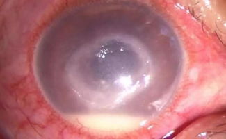 葡萄膜炎日常注意事項,葡萄膜炎飲食注意事項,葡萄膜炎癥狀注意事項