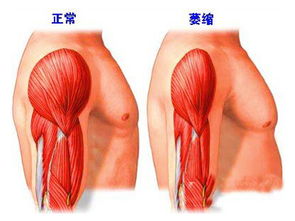 肌肉,手法,注意事項(xiàng),按摩