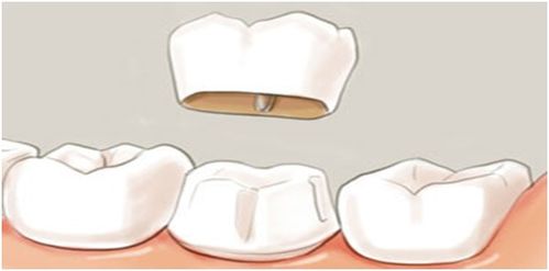 牙冠,注意事項(xiàng)