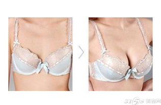 硅膠豐胸注意事項