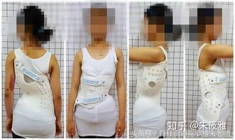 肢具佩戴注意事項(xiàng)