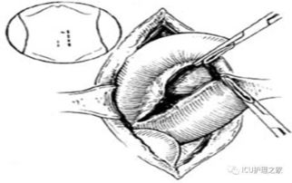 小腸造瘺術(shù)后注意事項,結(jié)腸造瘺術(shù)后注意事項,膀胱造瘺術(shù)后注意事項