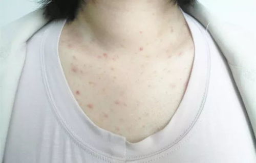 疥瘡,注意事項,毛囊炎