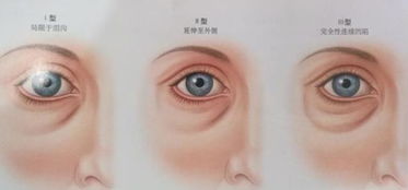 手術(shù)后,注意事項(xiàng),眼睛