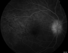 視神經(jīng),乳頭,注意事項