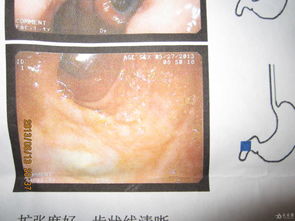 疣狀胃炎apc術(shù)后注意事項(xiàng),疣狀胃炎術(shù)后飲食細(xì)則,疣狀胃炎術(shù)后一個(gè)月疼