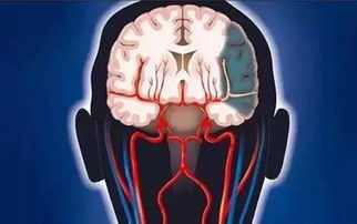 腦血栓后室外冷注意事項