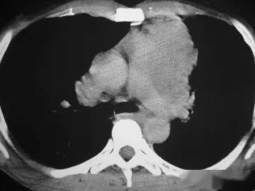 胸腺,化療,注意事項