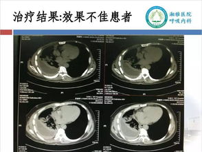 灌注,胸腔,注意事項