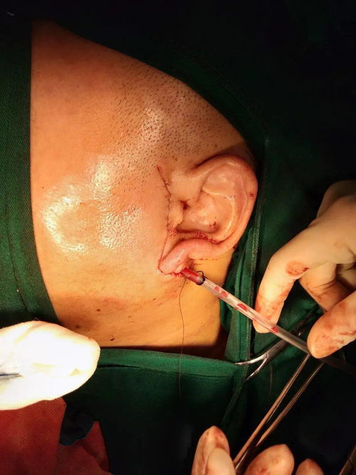 腮腺,注意事項(xiàng),瘤術(shù)中