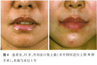 做完唇后應(yīng)注意事項