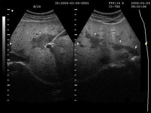 B超檢查注意事項(xiàng),肝臟B超檢查注意事項(xiàng),腹部B超檢查注意事項(xiàng)