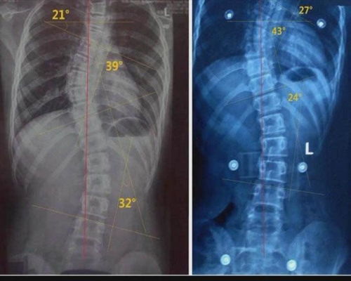 脊柱,注意事項,懷孕