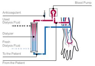 血液濾過的注意事項,血液濾過治療注意事項不正確的是,血液透析濾過的注意事項