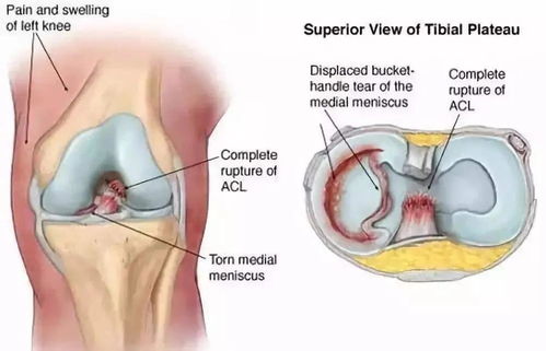膝蓋半月板損傷要注意事項(xiàng),小孩膝蓋半月板損傷如何治療,小孩膝蓋半月板損傷能恢復(fù)么