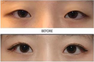 割雙眼皮注意事項(xiàng)?,埋線雙眼皮注意事項(xiàng),做雙眼皮需要注意事項(xiàng)