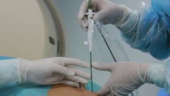 導(dǎo)管,消融,術(shù)后,注意事項(xiàng)