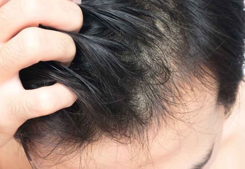 小兒頭皮靜脈輸液注意事項,小兒頭皮針注意事項,小兒頭皮靜脈注意事項