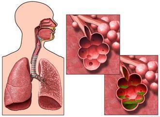 肺氣腫應(yīng)注意事項