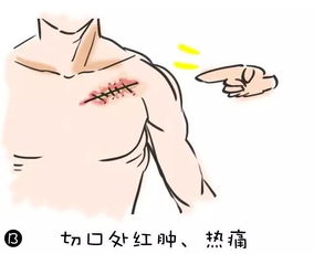 起搏器,術(shù)后,注意事項(xiàng)