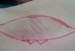 腳趾手術(shù)拆線后注意事項(xiàng)