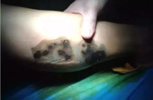 注意事項,手術(shù),電刀