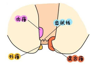 痔瘡術(shù)后十大注意事項,痔瘡手術(shù)后的注意事項,痔瘡術(shù)后注意事項及飲食禁忌