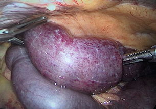 全麻,疝氣,手術(shù)后,注意事項