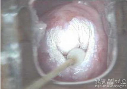 微波治療宮頸糜爛后注意事項,宮頸糜爛激光手術(shù)后注意事項,宮頸糜爛冷凍治療后注意事項