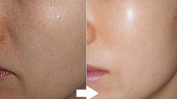 扶桑祛痘針注意事項(xiàng)