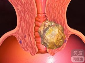 胰腺癌放化療的注意事項(xiàng),放化療期間注意事項(xiàng),鼻咽癌放化療后注意事項(xiàng)