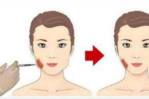 瘦臉針做后注意事項(xiàng)