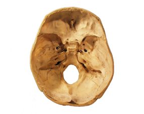 顱底骨折后應(yīng)注意事項(xiàng)