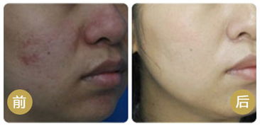 激光去痘印注意事項