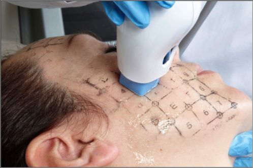 做完塑美極應(yīng)注意什么,做完酷塑注意事項(xiàng),做完鉆石超塑的注意事項(xiàng)