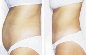 腰腹抽脂后飲食要注意事項